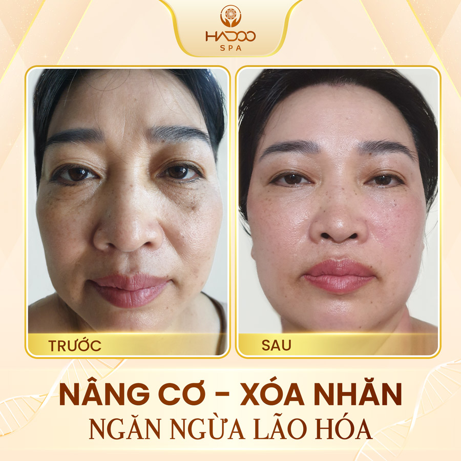 Face Lifting 1