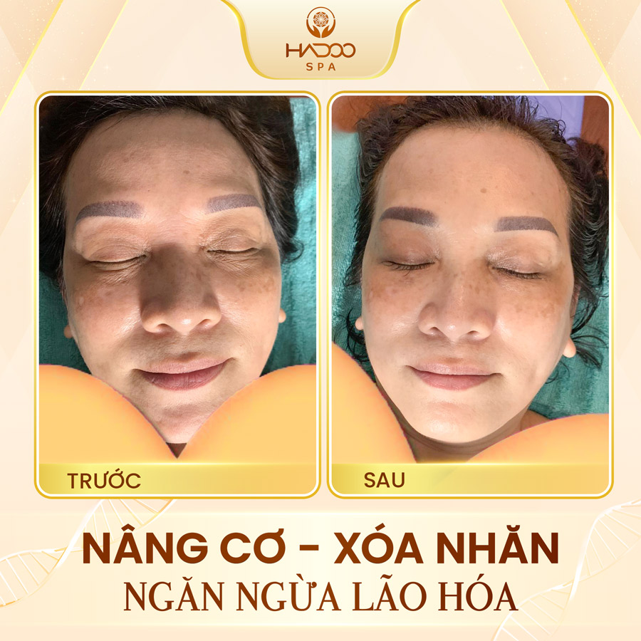Face Lifting 2