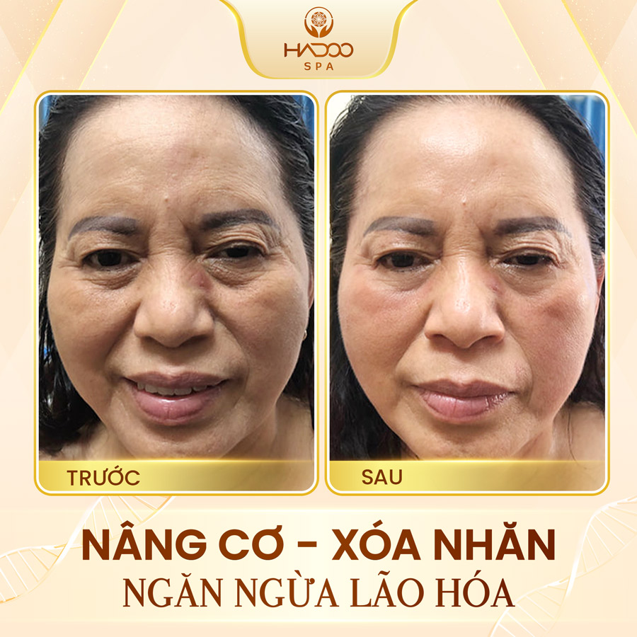 Face Lifting 3