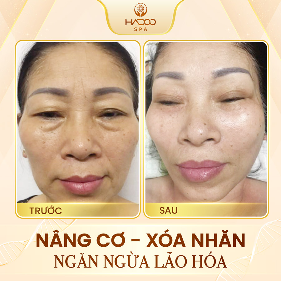 Face Lifting 4