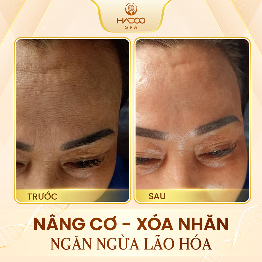 Face Lifting 5