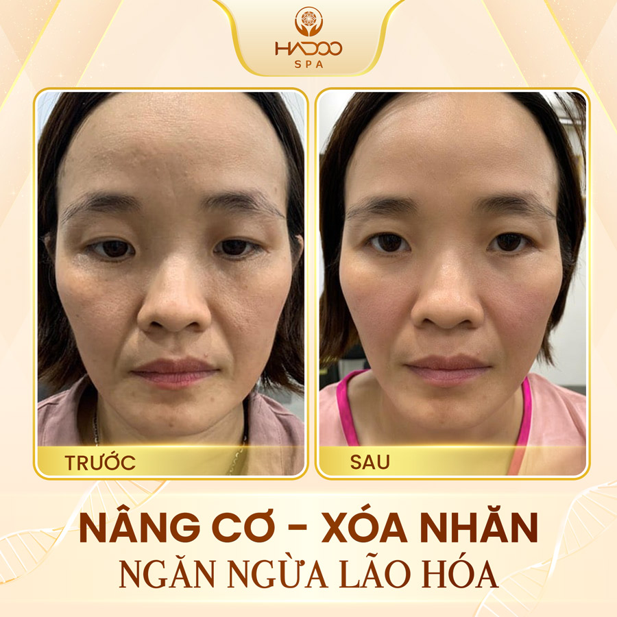 Face Lifting 6