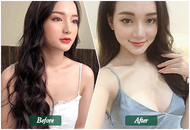 Before and After