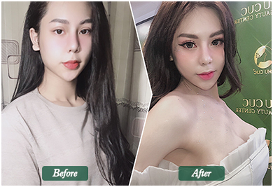 Before and After