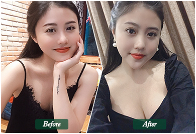 Before and After