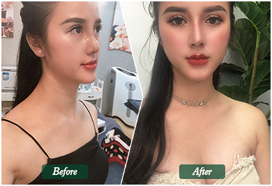 Before and After