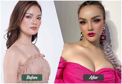 Before and After
